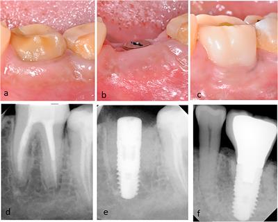 Case Report: Combining Molar Interradicular Osteotomy With Immediate Implant Placement: A Three-Year Case-Series Study